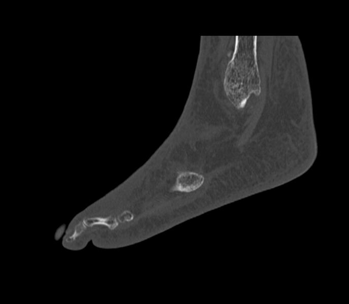 File:Calcaneal tuberosity avulsion fracture (Radiopaedia 22649-22668 Sagittal bone window 8).jpg
