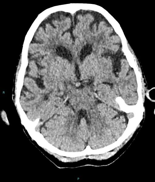 File:Calcified cerebral emboli from left ventricular thrombus (Radiopaedia 84420-99758 Axial non-contrast 62).jpg