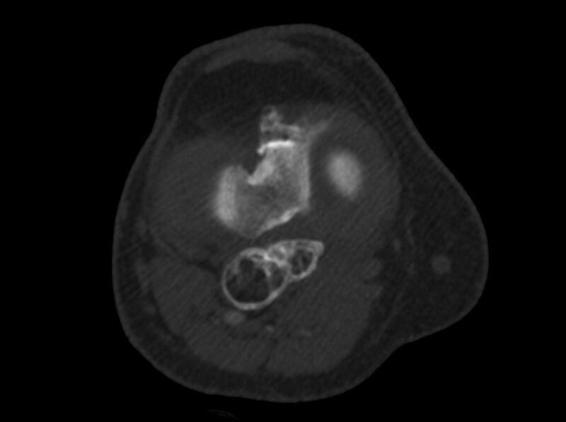 File:Calcified hematoma - popliteal fossa (Radiopaedia 63938-72763 C 26).jpg