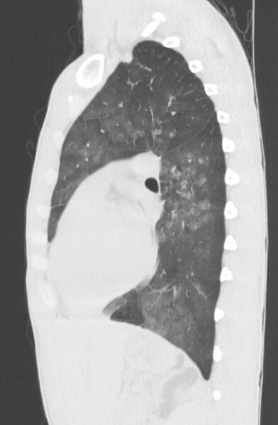 File:Cannabis-induced diffuse alveolar hemorrhage (Radiopaedia 89834-106946 Sagittal lung window 86).jpg
