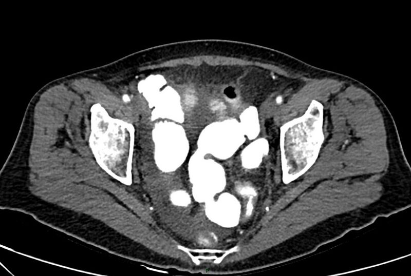 File:Carcinoid mesenteric tumor complicated by chylous ascites (Radiopaedia 76312-88926 A 67).jpg