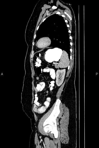 File:Carcinoma of uterine cervix (Radiopaedia 85861-101700 D 66).jpg