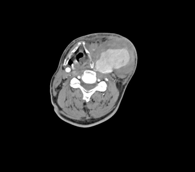 File:Carotid artery pseudoaneurysm (Radiopaedia 84030-99259 C 46).jpg