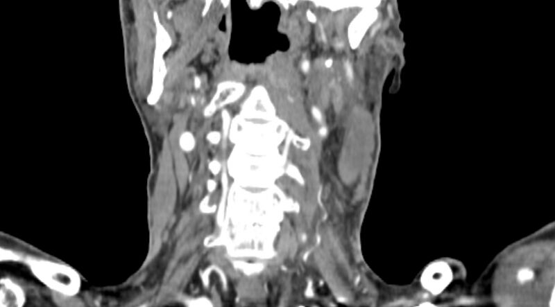 File:Carotid artery pseudoaneurysm (Radiopaedia 84030-99259 D 54).jpg