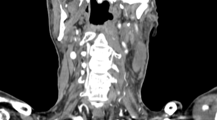 Carotid artery pseudoaneurysm (Radiopaedia 84030-99259 D 54).jpg