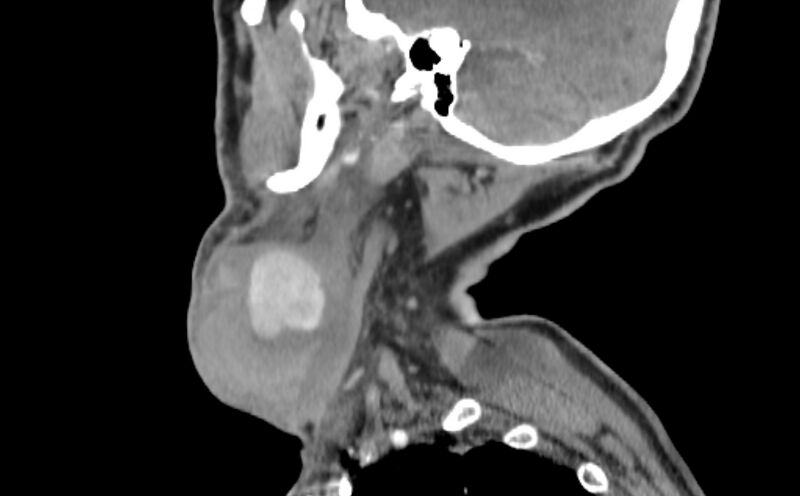 File:Carotid artery pseudoaneurysm (Radiopaedia 84030-99259 E 47).jpg