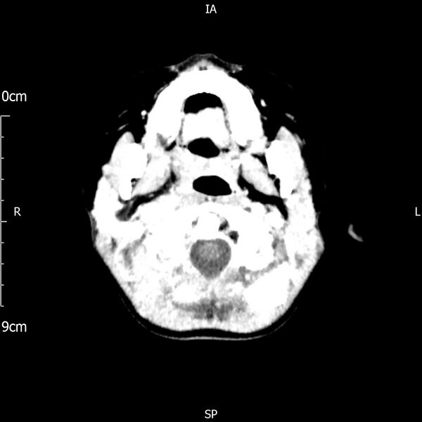 File:Cavernous sinus thrombosis (Radiopaedia 79414-92510 Axial Brain 41).jpg