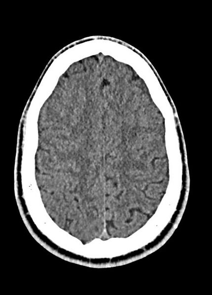 File:Cavum septum pellucidum and cavum vergae (Radiopaedia 77797-90060 Axial Brain Window 80).jpg