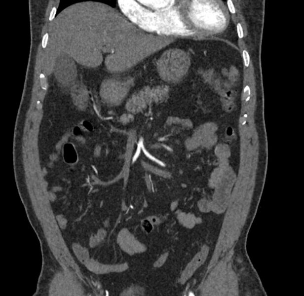 File:Celiac artery dissection (Radiopaedia 52194-58080 C 8).jpg