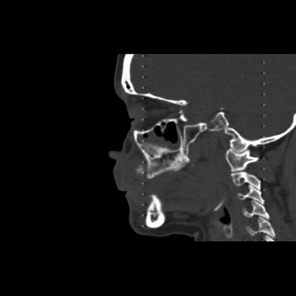 File:Cemento-ossifying fibroma (Radiopaedia 21243-21149 Sagittal bone window 12).jpg