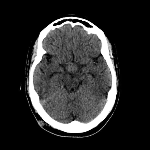 File:Central nervous system Langerhans cell histiocytosis (Radiopaedia 65728-74878 Axial non-contrast 21).jpg