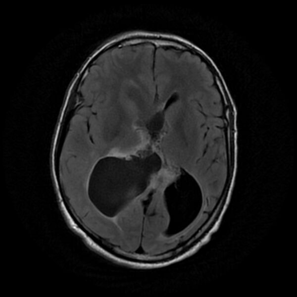 File:Central neurocytoma (Radiopaedia 67618-77021 Axial FLAIR 13).jpg