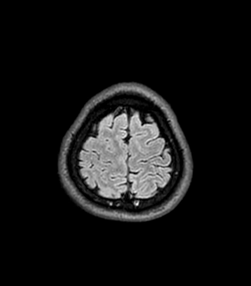 Central neurocytoma (Radiopaedia 79320-92380 Axial FLAIR 54).jpg