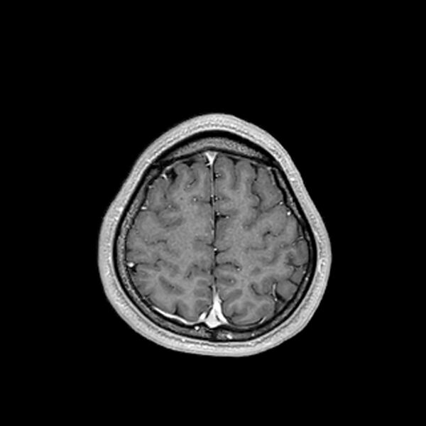 File:Central neurocytoma (Radiopaedia 79320-92380 Axial T1 C+ 196).jpg