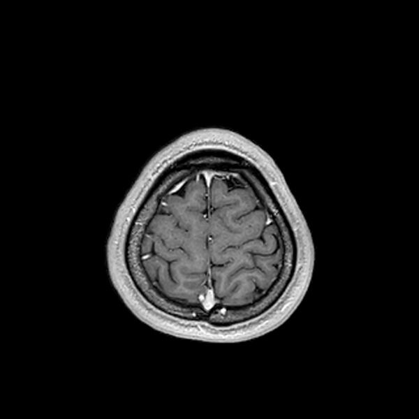 File:Central neurocytoma (Radiopaedia 79320-92380 Axial T1 C+ 207).jpg