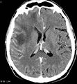 Cerebral abscesses secondary to contusions (Radiopaedia 5201-6967 Axial C+ delayed 1).jpg