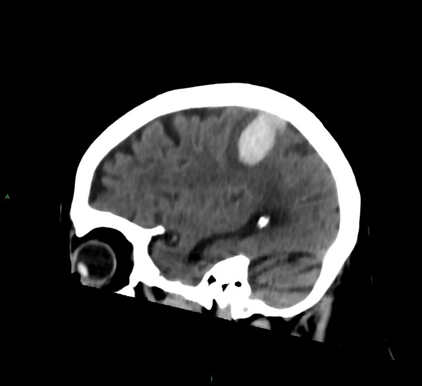 Cerebral amyloid angiopathy-associated lobar intracerebral hemorrhage (Radiopaedia 58376-65513 C 26).jpg