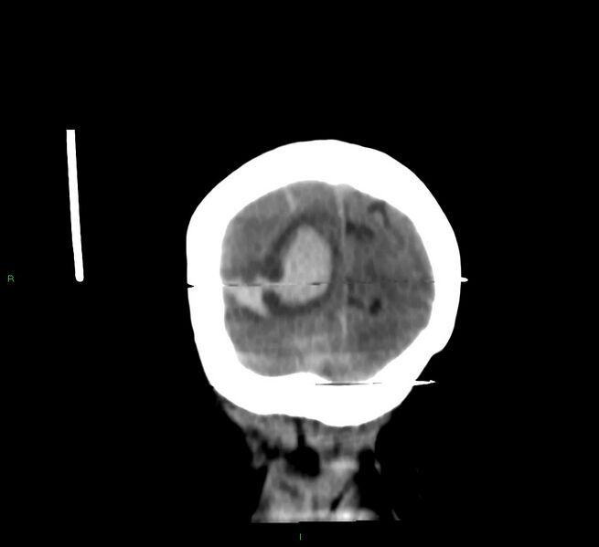 File:Cerebral amyloid angiopathy-associated lobar intracerebral hemorrhage (Radiopaedia 58377-65514 Coronal non-contrast 10).jpg