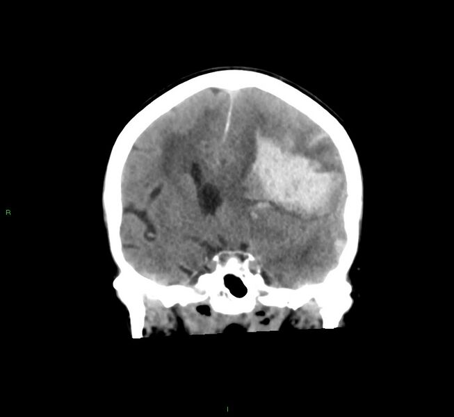 File:Cerebral amyloid angiopathy-associated lobar intracerebral hemorrhage (Radiopaedia 58561-65724 Coronal non-contrast 36).jpg