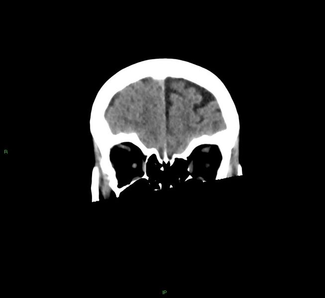 File:Cerebral amyloid angiopathy-associated lobar intracerebral hemorrhage (Radiopaedia 58563-65727 Coronal non-contrast 53).jpg