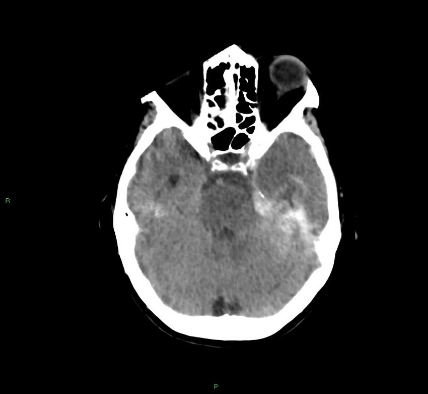 Cerebral amyloid angiopathy-associated lobar intracerebral hemorrhage (Radiopaedia 58754-65975 Axial non-contrast 42).jpg