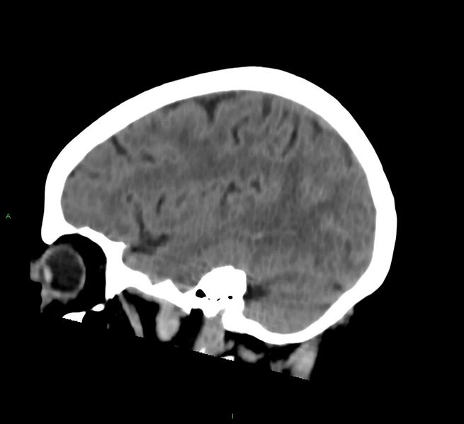 File:Cerebral amyloid angiopathy-associated lobar intracerebral hemorrhage (Radiopaedia 58757-65978 C 39).jpg