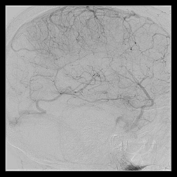 File:Cerebral aneurysm with rupture (Radiopaedia 29933-30458 LT CCA IC 46).jpg