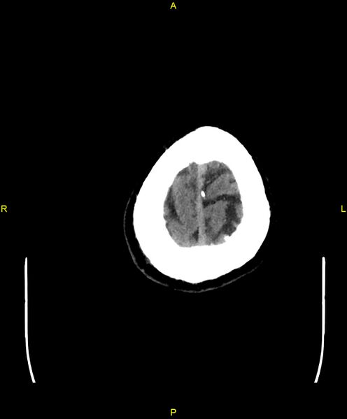 File:Cerebral autosomal dominant arteriopathy with subcortical infarcts and leukoencephalopathy (CADASIL) (Radiopaedia 86108-102051 Axial non-contrast 108).jpg