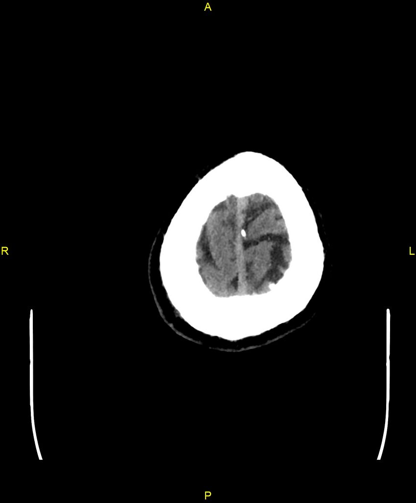 Cerebral autosomal dominant arteriopathy with subcortical infarcts and leukoencephalopathy (CADASIL) (Radiopaedia 86108-102051 Axial non-contrast 108).jpg