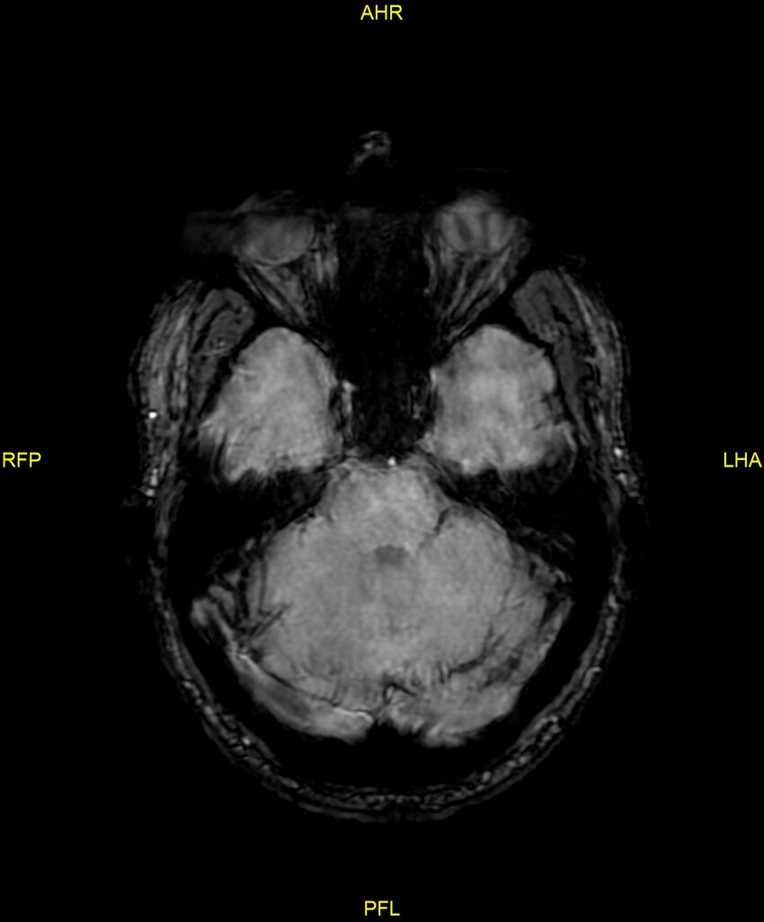 Cerebral autosomal dominant arteriopathy with subcortical infarcts and leukoencephalopathy (CADASIL) (Radiopaedia 86108-102054 Axial SWI 35).jpg
