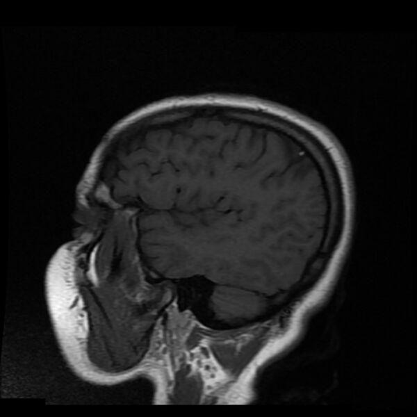 File:Cerebral cavernous malformation (Radiopaedia 44301-47942 Sagittal T1 3).jpg