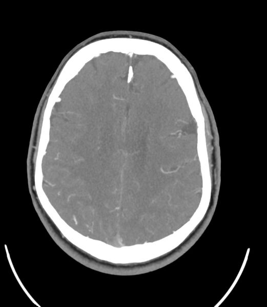 File:Cerebral dural venous sinus thrombosis (Radiopaedia 86514-102576 A 69).jpg