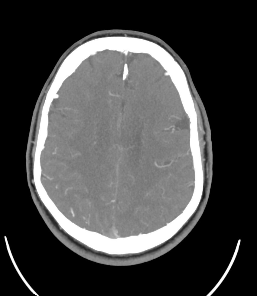 Cerebral dural venous sinus thrombosis (Radiopaedia 86514-102576 A 69).jpg
