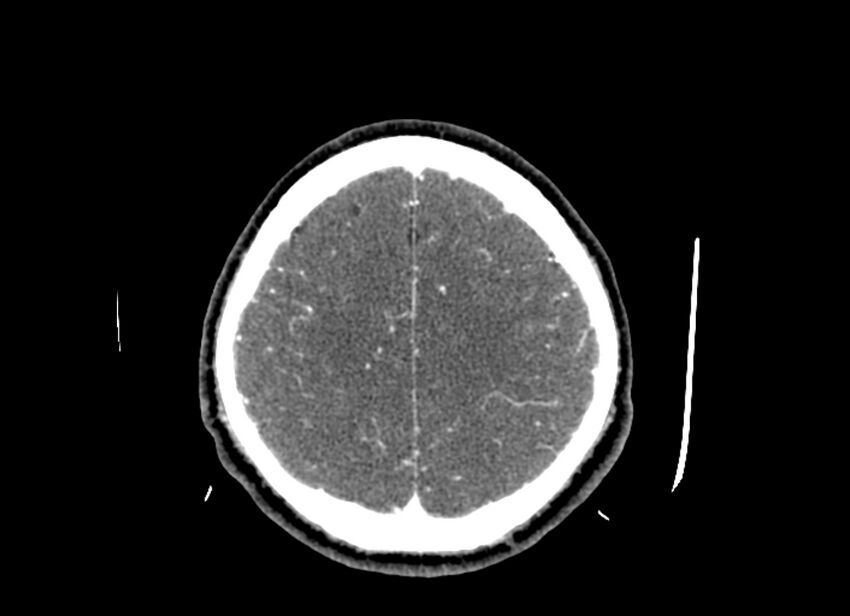 Cerebral edema (Radiopaedia 82519-96661 B 17).jpg