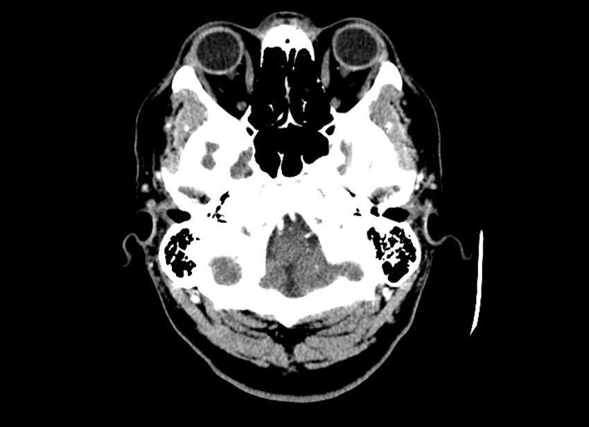 Cerebral edema (Radiopaedia 82519-96661 B 49).jpg