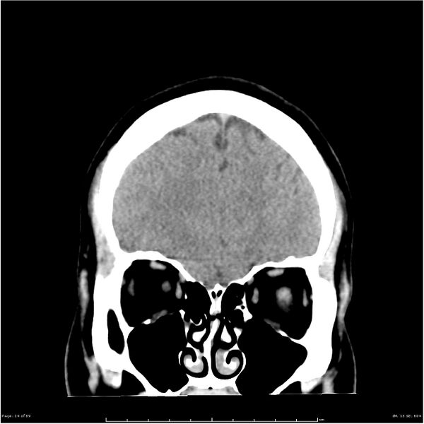 File:Cerebral hemorrhage secondary to arteriovenous malformation (Radiopaedia 33497-34561 Coronal non-contrast 5).jpg