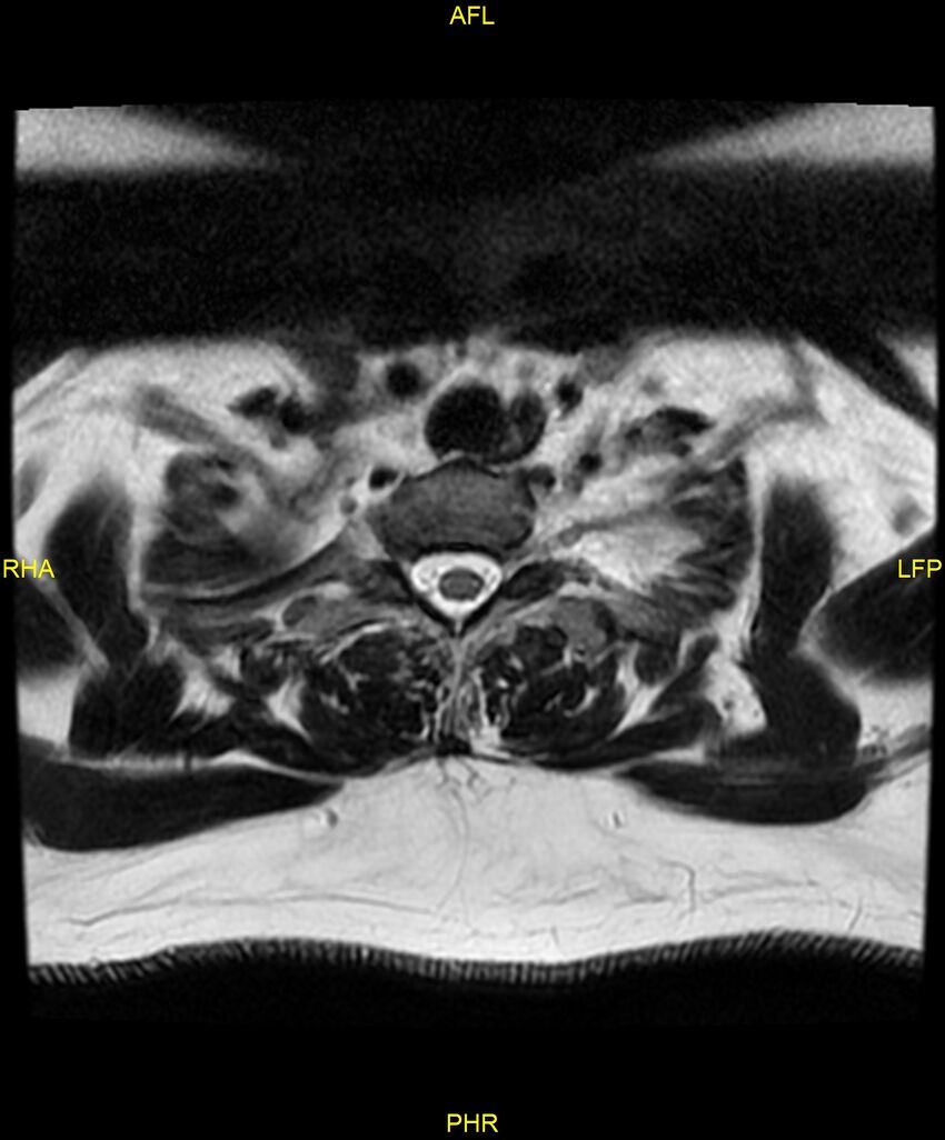 Cervical disc protrusion (Radiopaedia 87147-103415 Axial T2 82).jpg