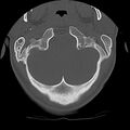 Cervical flexion teardrop fracture with cord hemorrhage (Radiopaedia 32497-33454 Axial bone window 9).jpg