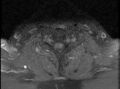 Cervical schwannoma (Radiopaedia 72399-82934 Axial T1 C+ fat sat 18).jpg