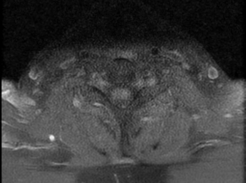 File:Cervical schwannoma (Radiopaedia 72399-82934 Axial T1 C+ fat sat 18).jpg