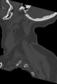 Cervical spine ACDF loosening (Radiopaedia 48998-54070 Sagittal bone window 16).png