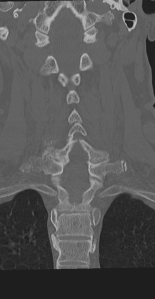 File:Cervical spine fracture in the setting of ankylosis (Radiopaedia 37038-38715 Coronal bone window 42).png