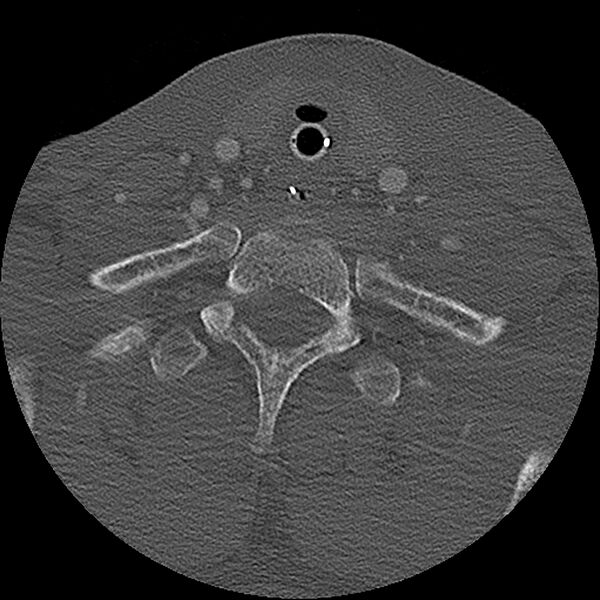 File:Cervical spine fractures with vertebral artery dissection (Radiopaedia 32135-33078 Axial bone window 2).jpg