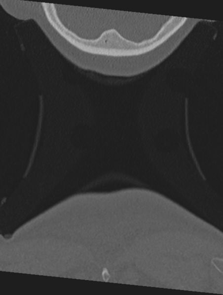 File:Cervical spondylolysis (Radiopaedia 49616-54811 Coronal bone window 78).png