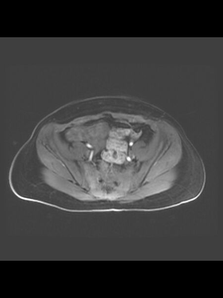 File:Cesarean section scar endometrioma (Radiopaedia 56569-63297 Axial T1 C+ fat sat 33).jpg
