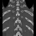 Chance fracture (Radiopaedia 36521-38081 Coronal bone window 51).jpg