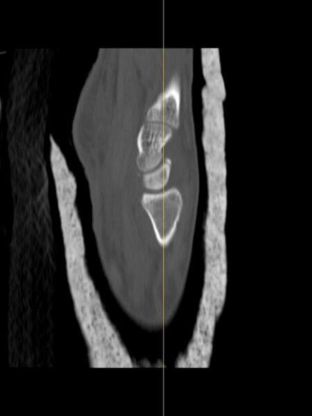 File:Chauffeur's (Hutchinson) fracture (Radiopaedia 58043-65079 Sagittal bone window 12).jpg