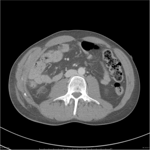 File:Chest and abdomen multi-trauma (Radiopaedia 26294-26426 A 45).jpg