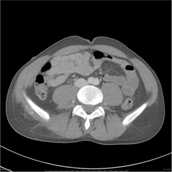 File:Chest and abdomen multi-trauma (Radiopaedia 26294-26426 bone window 55).jpg