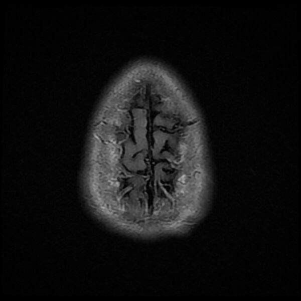 File:Chiasmatic-hypothalamic juvenile pilocytic astrocytoma (Radiopaedia 78533-91235 Axial FLAIR 26).jpg
